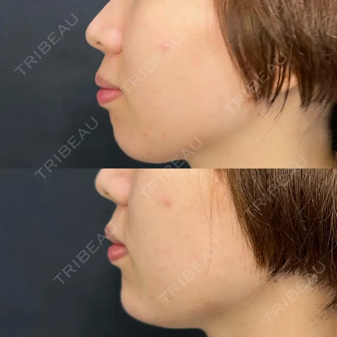 ボトックス（あご） / ヒアルロン酸注入（あご） ルラ美容クリニック 渋谷本院 BEFORE メイン用