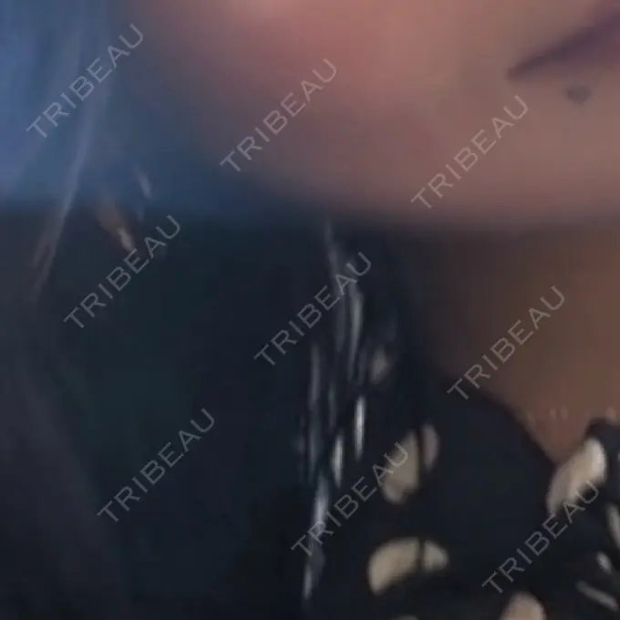 ボトックス（エラ・小顔） TCB東京中央美容外科 心斎橋院 BEFORE メイン用