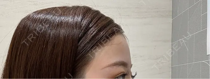 ヒアルロン酸注入（額） LA CLEF CLINIC（ラクレクリニック） BEFORE メイン用