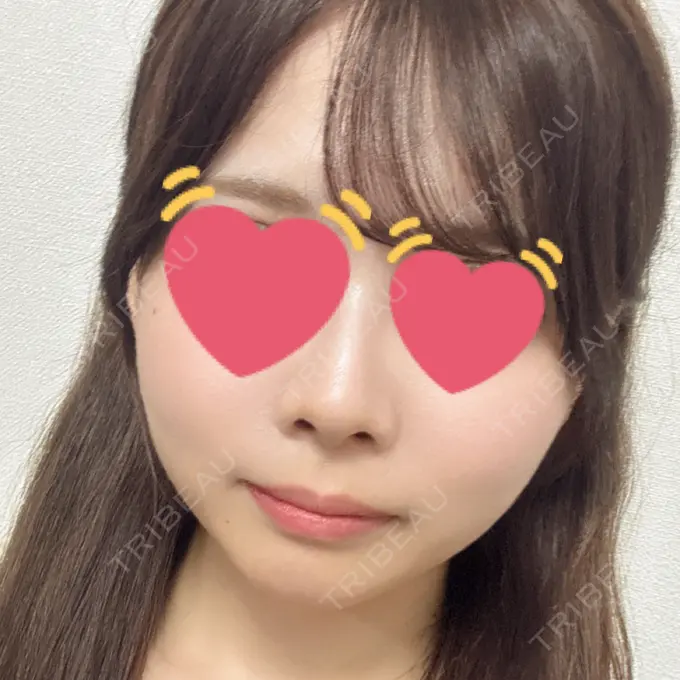 バッカルファット除去 / 脂肪吸引（顔） / メーラーファット除去 / ヒアルロン酸注入（あご） PRISM Beauty Clinic 町田院 BEFORE メイン用