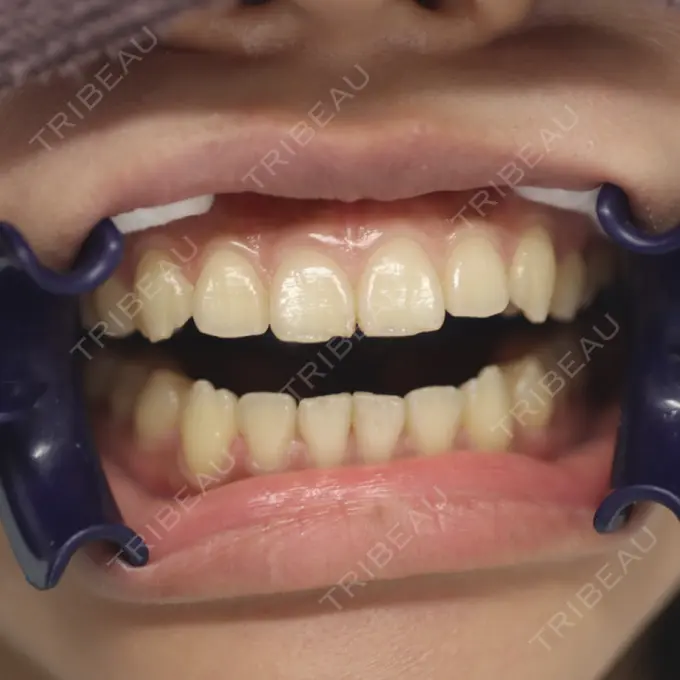 その他 目黒まついデンタルクリニック BEFORE メイン用