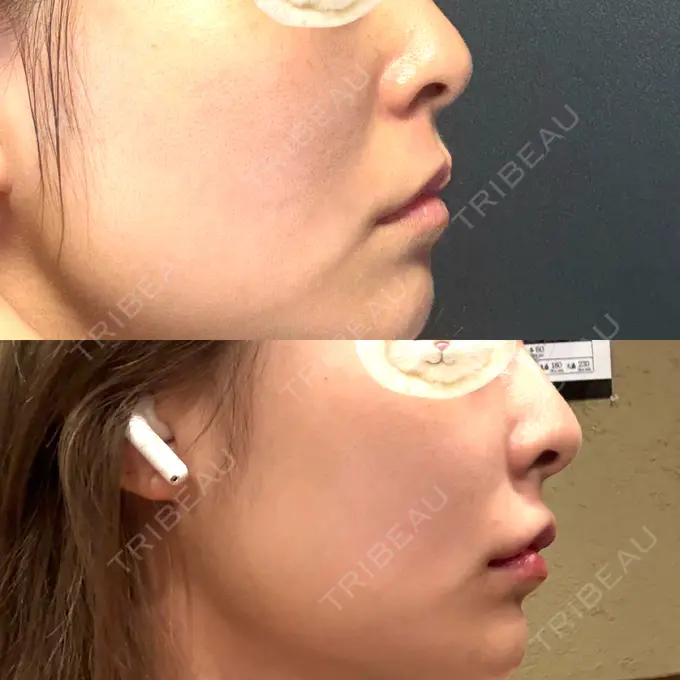 ヒアルロン酸注入（あご） / ヒアルロン酸注入（唇） / ヒアルロン酸注入（額） / ヒアルロン酸注入（こめかみ） / ヒアルロン酸注入（鼻翼基部） ライブリークリニック 浜松町院 BEFORE メイン用