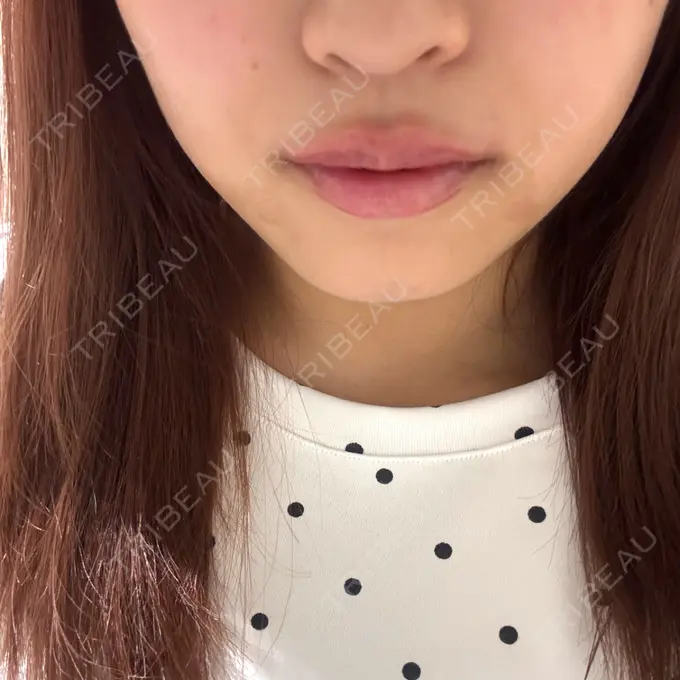 ヒアルロン酸注入（唇） / ボトックス（口角） / その他（口元） 銀座美容外科クリニック 銀座院 BEFORE メイン用