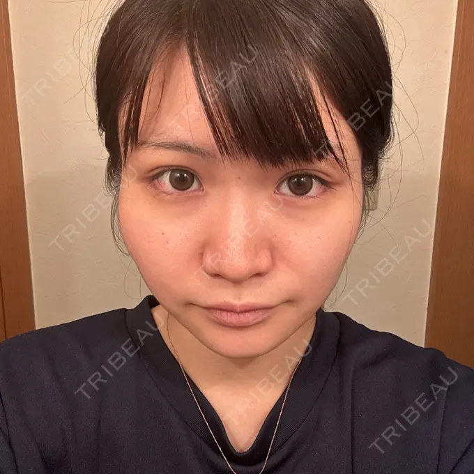 隆鼻術 / 鼻尖形成（切開） / 軟骨移植 / ワシ鼻修正・ハンプ切除 ダビダ整形外科 BEFORE メイン用