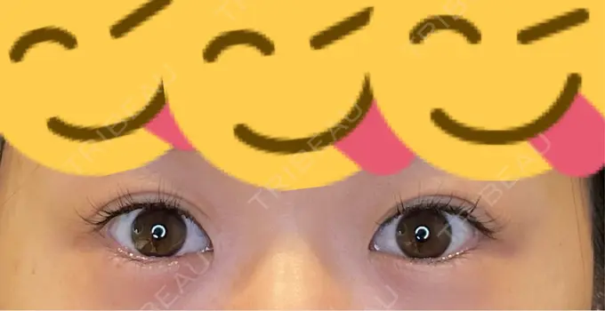 目尻切開 / タレ目形成・グラマラスライン（埋没） / ボトックス（人中） LOUIS CLINIC 二子玉川院【ルイクリニック】 BEFORE メイン用