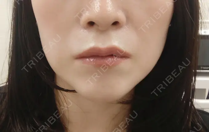 ボトックス（エラ・小顔） 新宿TAクリニック BEFORE メイン用