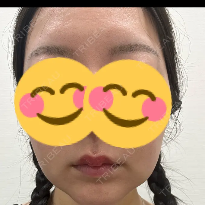 ヒアルロン酸注入（唇） 新未来クリニック BEFORE メイン用