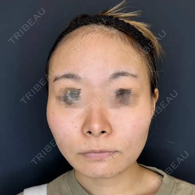 脂肪吸引（顔） ルラ美容クリニック 大宮院 / ルラスキンクリニック 大宮院 BEFORE メイン用