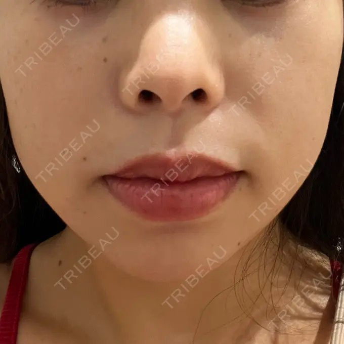 ハイフ（顔） Designo Clinic （デジーノクリニック） BEFORE メイン用