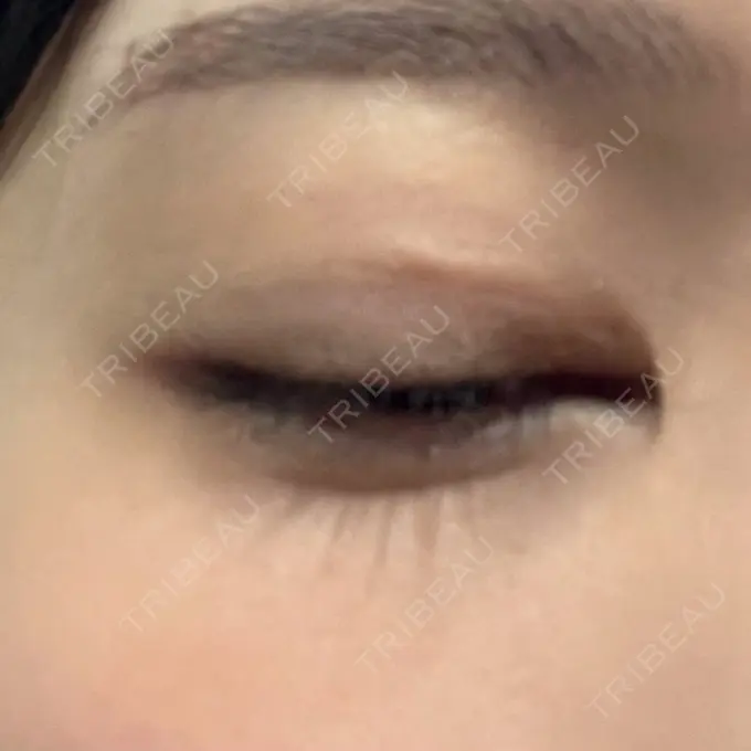 その他（目元） BITO BEAUTY CLINIC BEFORE メイン用