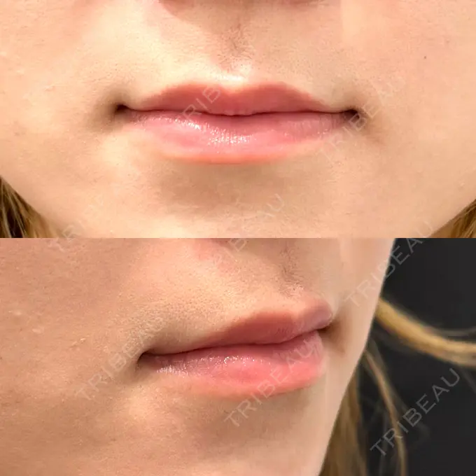 ヒアルロン酸注入（唇） 大美会クリニック 神戸院 BEFORE メイン用