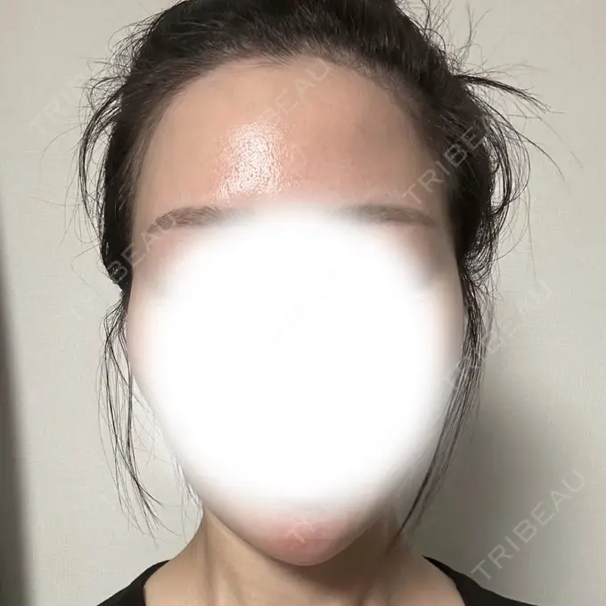 ハイフ（顔） ミニマムスキンクリニック池袋 BEFORE メイン用