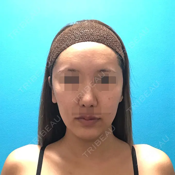 骨切り（あご） / 骨削り（頬） / ルフォー+ssro（両あご) / 輪郭修正 / 鼻翼基部形成（貴族手術） / その他（輪郭） エバーエム歯科 BEFORE メイン用