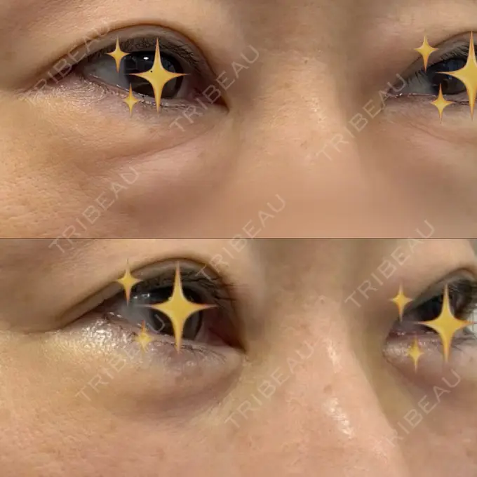 クマ治療 / 下まぶたの脂肪取り ライブリークリニック 船橋院 BEFORE メイン用