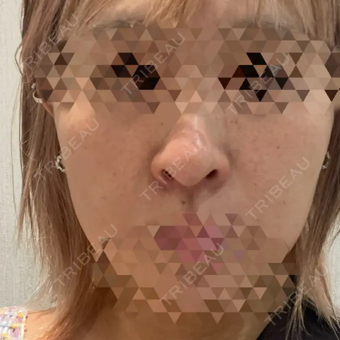 ヒアルロン酸注入（鼻翼基部） サラン鶴橋皮フ科 BEFORE メイン用