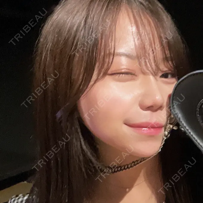 ヒアルロン酸注入（鼻） / ヒアルロン酸注入（あご） PRISM Beauty Clinic 町田院 BEFORE メイン用