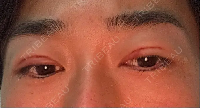 二重埋没 ルラ美容クリニック 渋谷本院 BEFORE メイン用