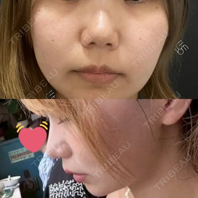 糸リフト / 鼻翼基部形成（貴族手術） / その他（鼻） EMMO FACE CLINIC 東京三田院 BEFORE メイン用