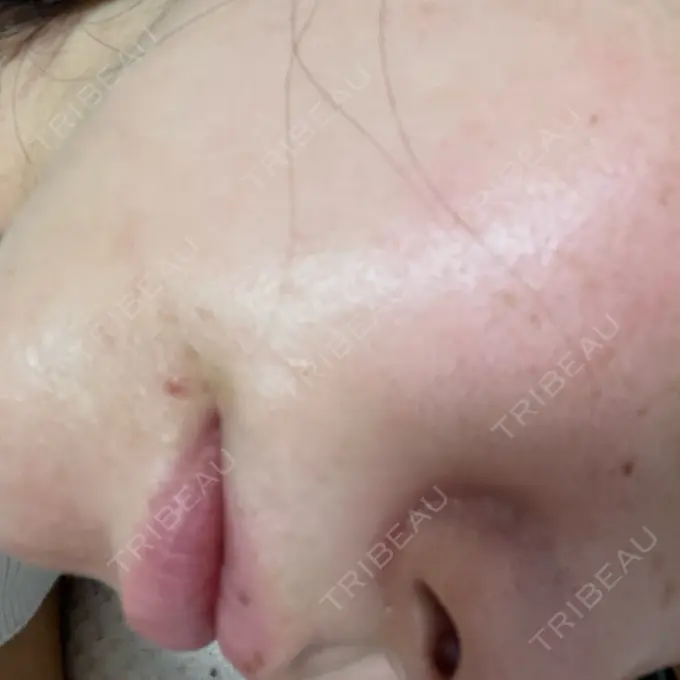 ピーリング（ニキビ・毛穴） 共立美容外科 浜松院 BEFORE メイン用