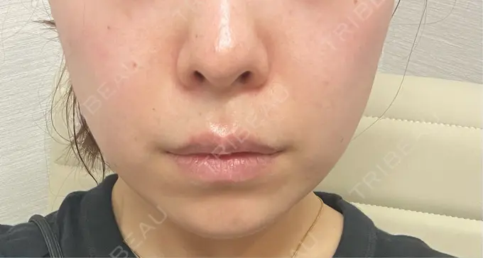 ハイフ（顔） 東京美容外科 池袋院 BEFORE メイン用