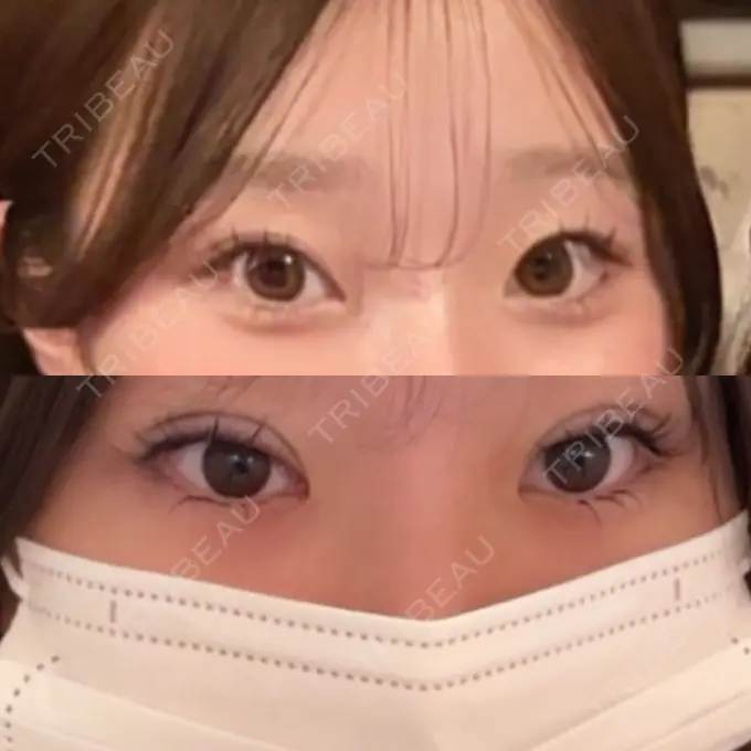 二重埋没 / 目元修正 東京シンデレラ美容外科 池袋院 BEFORE メイン用