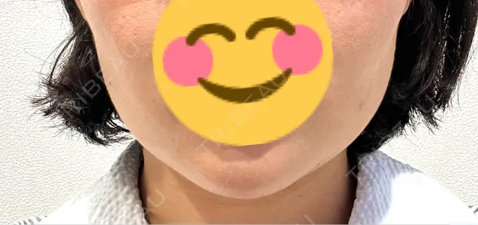 糸リフト / 脂肪吸引（顔） / 脂肪吸引注射（顔） ziz CLINIC BEFORE メイン用