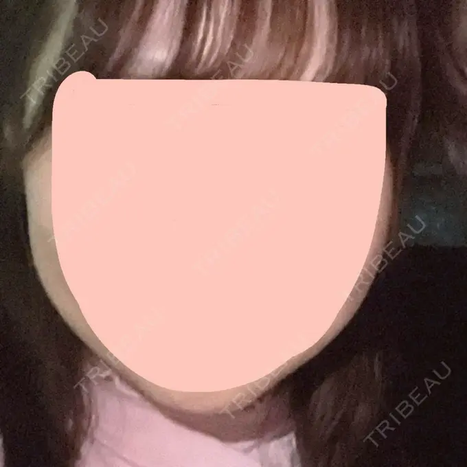 糸リフト TCB東京中央美容外科 浜松院 BEFORE メイン用