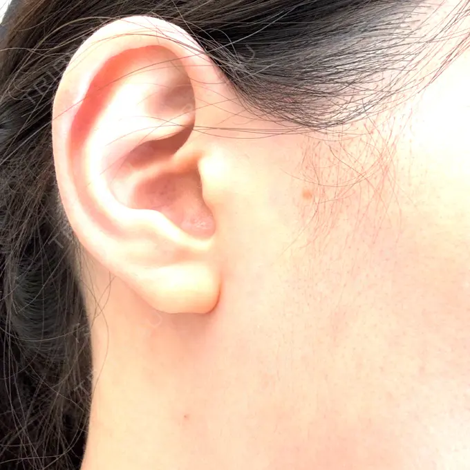 ほくろ・いぼ除去レーザー（肌） 共立美容外科 福岡院 BEFORE メイン用