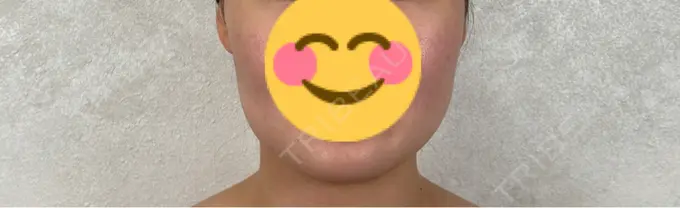 糸リフト / バッカルファット除去 / 脂肪吸引（顔） アリエル美容クリニック 横浜院 BEFORE メイン用