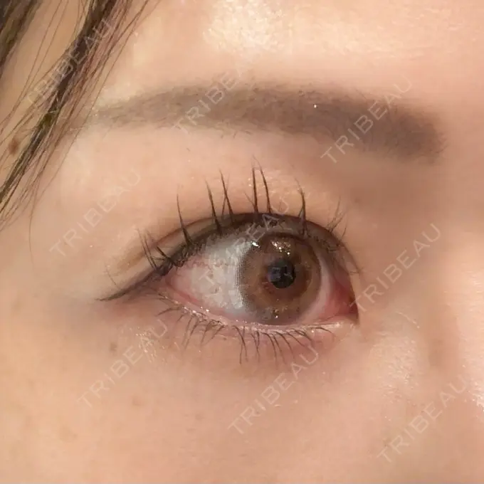 ヒアルロン酸注入（涙袋） 新宿TAクリニック BEFORE メイン用