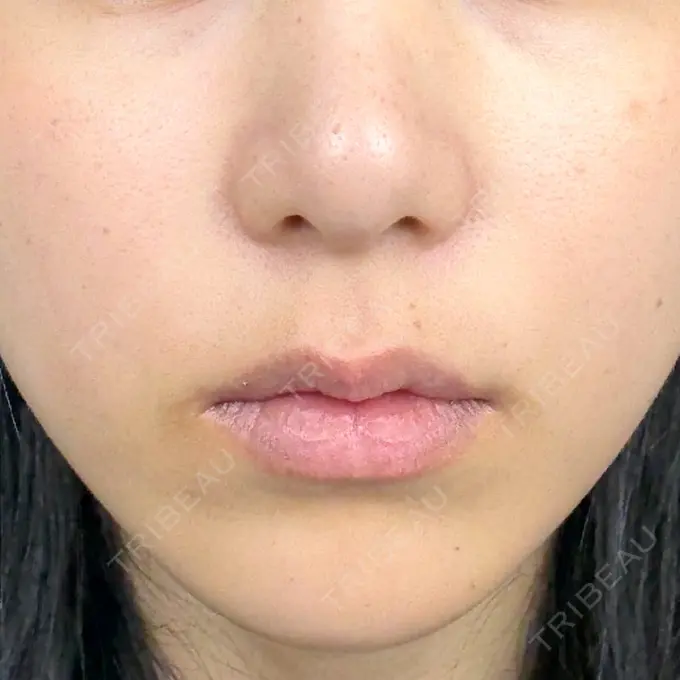 ルメッカ さっぽろ美容クリニック BEFORE メイン用