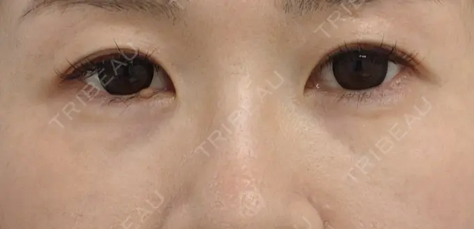 ヒアルロン酸注入（目の下） SOL CLINIC BEFORE メイン用