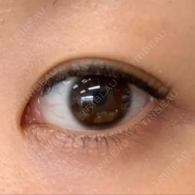 目尻切開 湘南美容クリニック 表参道院 BEFORE メイン用