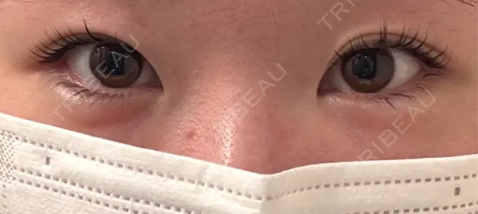 二重埋没 / 目頭切開 eクリニック 福岡院 BEFORE メイン用