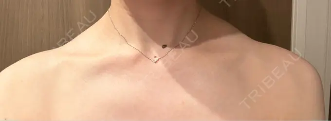 ボトックス（肩） ルラ美容クリニック 静岡院 BEFORE メイン用