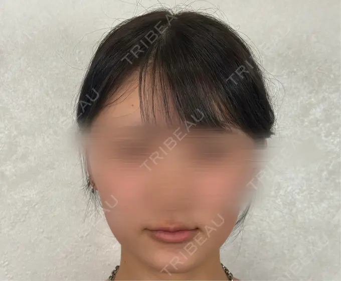 ヒアルロン酸注入（唇） アリエル美容クリニック 横浜院 BEFORE メイン用