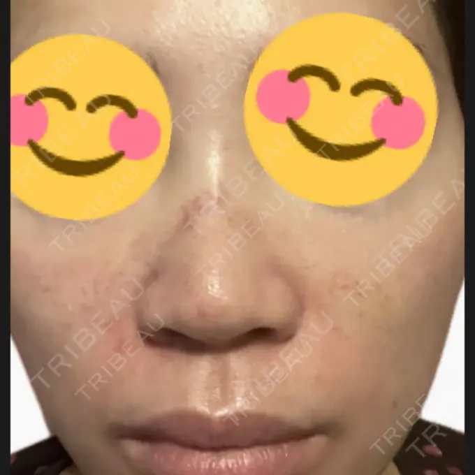 プラセンタ注射 / その他（肌） 美容皮膚科エルムクリニック 麻布院 BEFORE メイン用