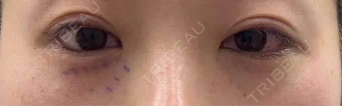 クマ治療 小倉美容外科ネビュラクリニック BEFORE メイン用