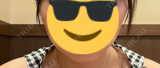 ボトックス（エラ・小顔） 共立美容外科 立川院 BEFORE メイン用