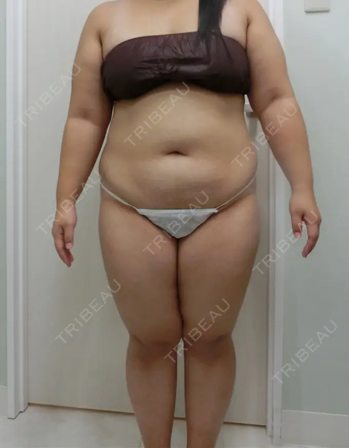 バッカルファット除去 / 脂肪吸引（顔） / 脂肪吸引（二の腕） / 脂肪吸引（脚） / 脂肪吸引（お腹） ジョウクリニック 那覇院 BEFORE メイン用