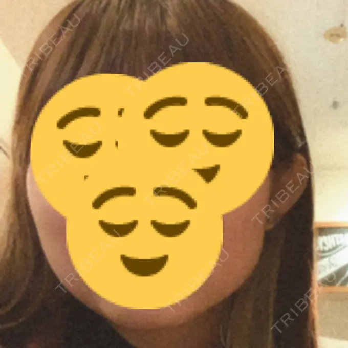 ボトックス（エラ・小顔） もとび美容外科クリニック 新宿院 BEFORE メイン用