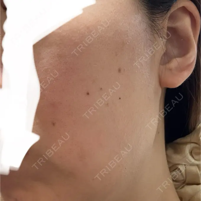 ハイフ（顔） / ピーリング（ハリ・ツヤ） メディアージュクリニック 青山院 BEFORE メイン用