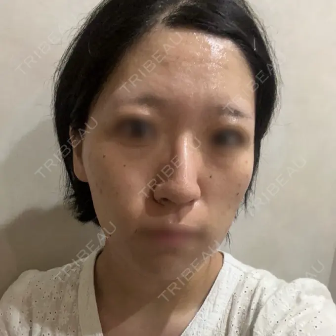 医療脱毛（顔） Sea Sail Beauty Clinic BEFORE メイン用