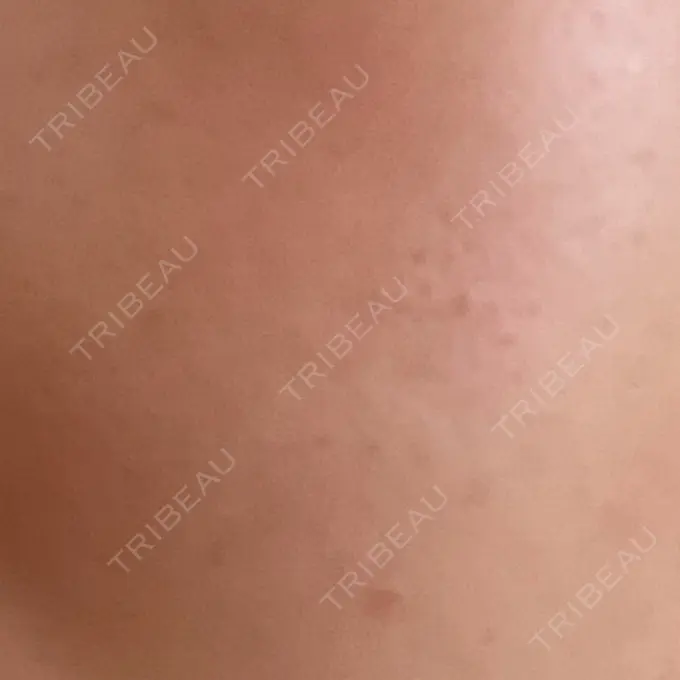 ピーリング（ニキビ・毛穴） 大美会クリニック 岡山院 BEFORE メイン用