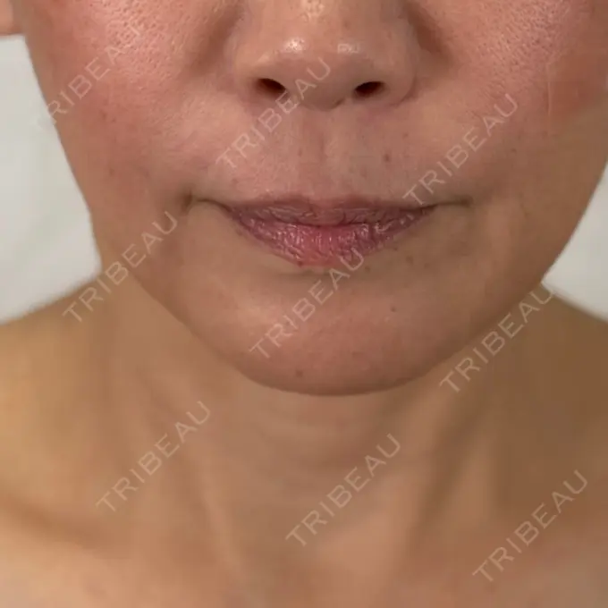 糸リフト / 肌ヒアルロン酸注入（たるみ・シワ改善） アリエル美容クリニック 横浜院 BEFORE メイン用