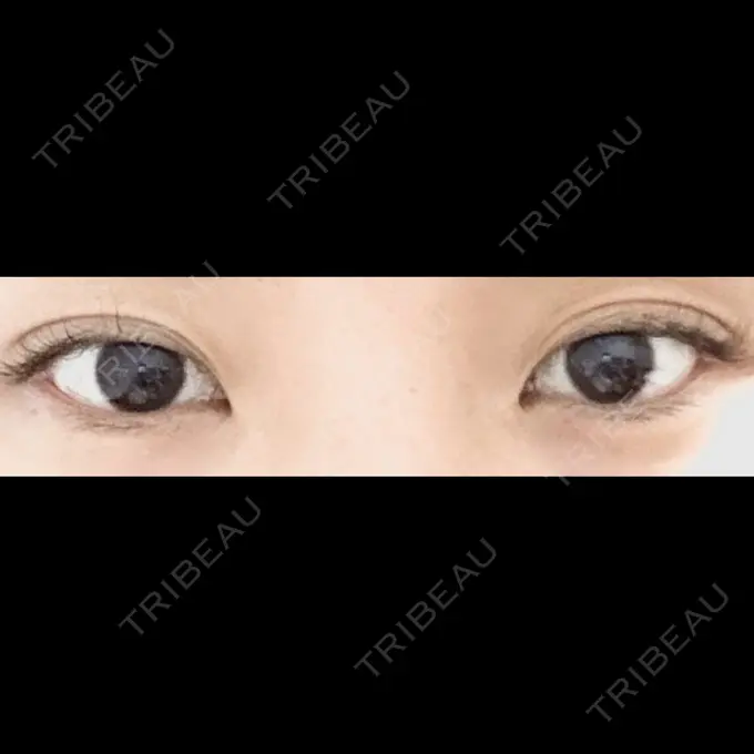 二重埋没 ドクター松井クリニック 新宿 BEFORE メイン用