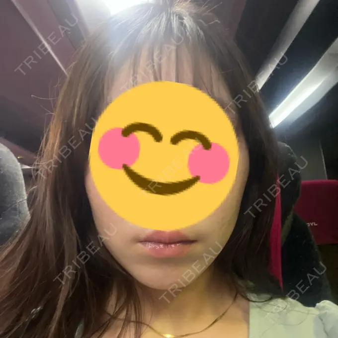 糸リフト / 脂肪吸引（顔） / ボトックス（エラ・小顔） RIVER CLINIC（リバークリニック） BEFORE メイン用