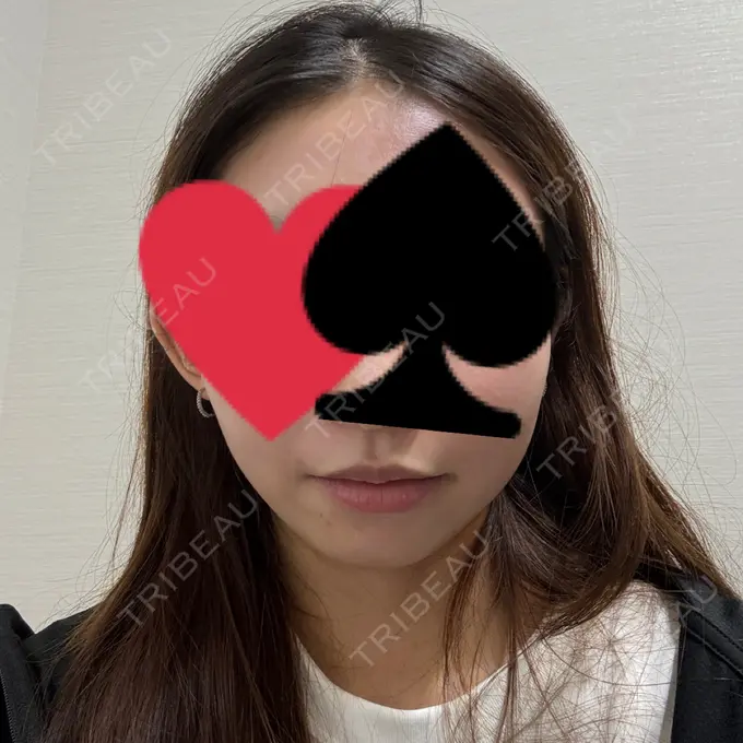 ハイフ（顔） 東京美容外科 池袋院 BEFORE メイン用