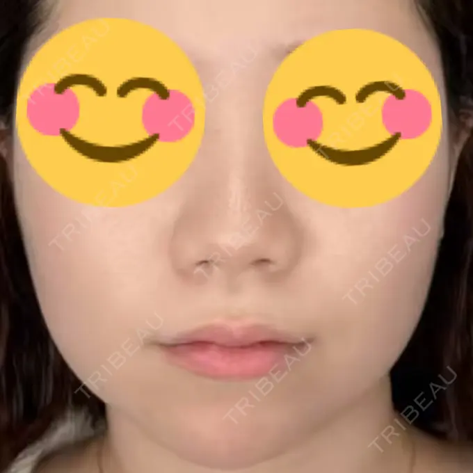 鼻尖形成（切開） / 小鼻縮小（切開） / 軟骨移植 / 鼻尖縮小 ASTRA BEAUTY CLINIC BEFORE メイン用