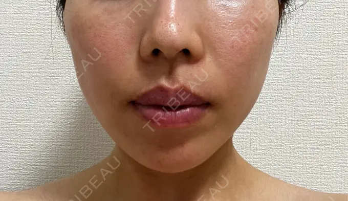 ボトックス（あご） / ボトックス（エラ・小顔） TCB東京中央美容外科 金山院 BEFORE メイン用